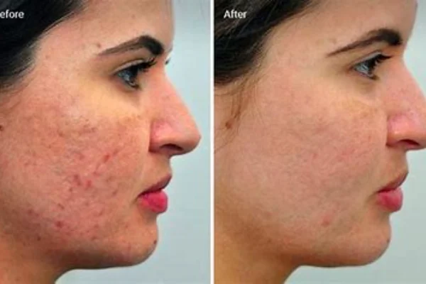 ErYAG laser repair of scars-crylink